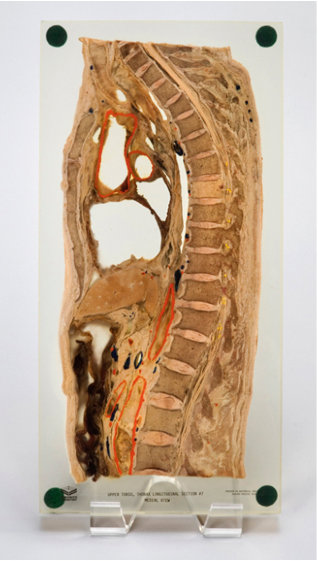 Sagittal Section of Human Spine Preserved in Arcrylic