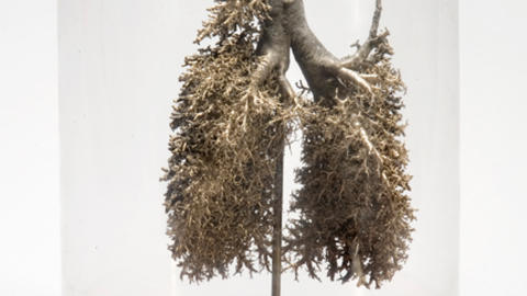 Corrosion cast of bronchi and trachea