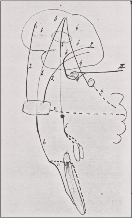 Drawing of Neuropathology